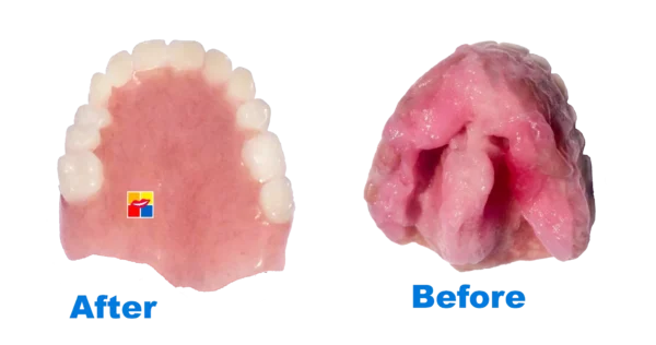 Denatlwig Partial or Full on Upper Jaw - Image 5