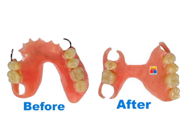 DentalWig  Partial Or Full Upper Jaw - Image 2